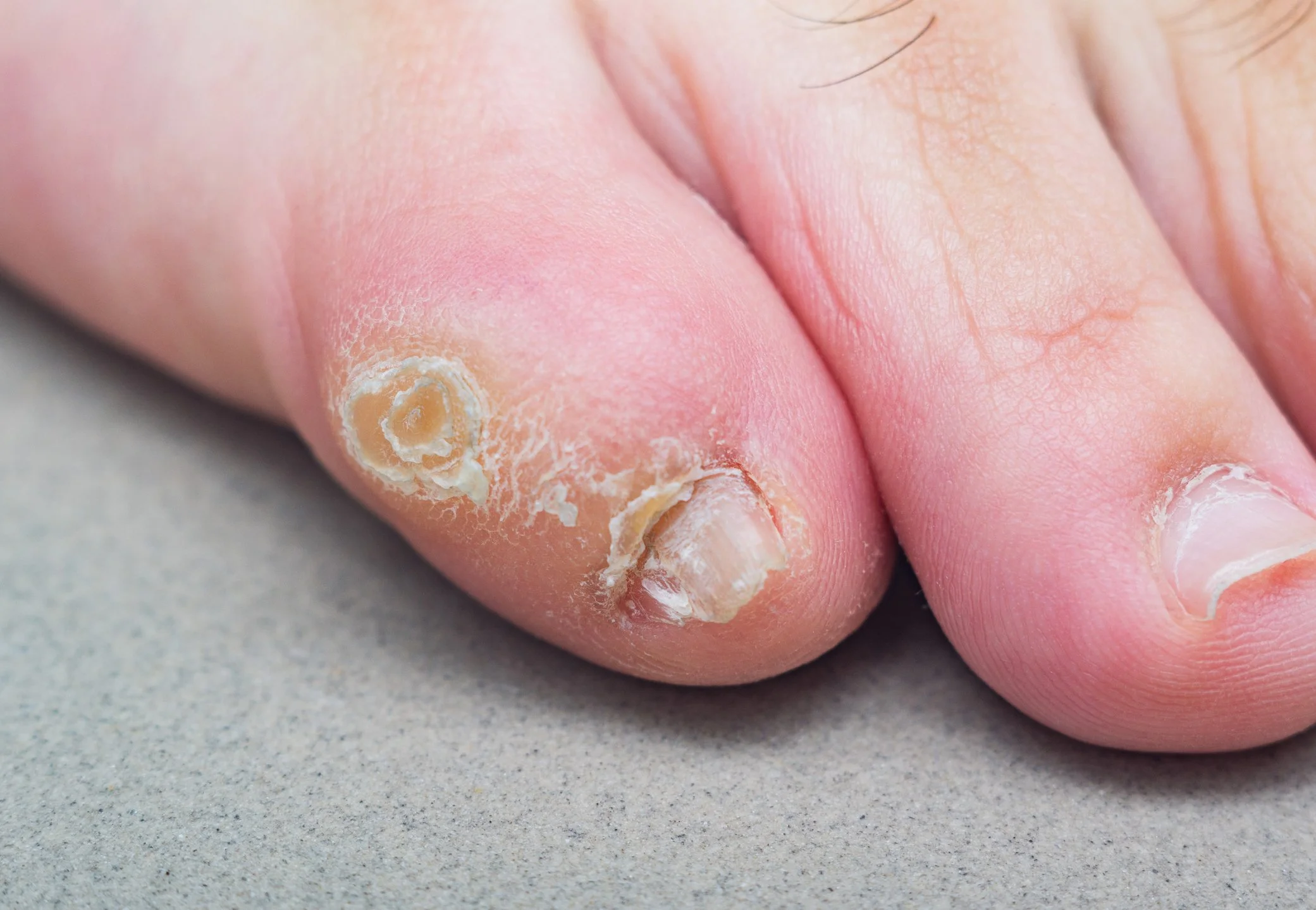 Image of a large uncomfortable looking corn located on the top of a small toe.