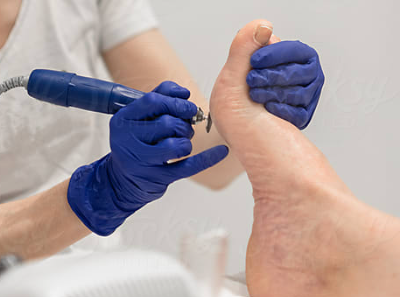 This image shows someone's foot being treated by a chiropodist or foot health practitioner.  The chiropodist is using a handheld podiatry drill.