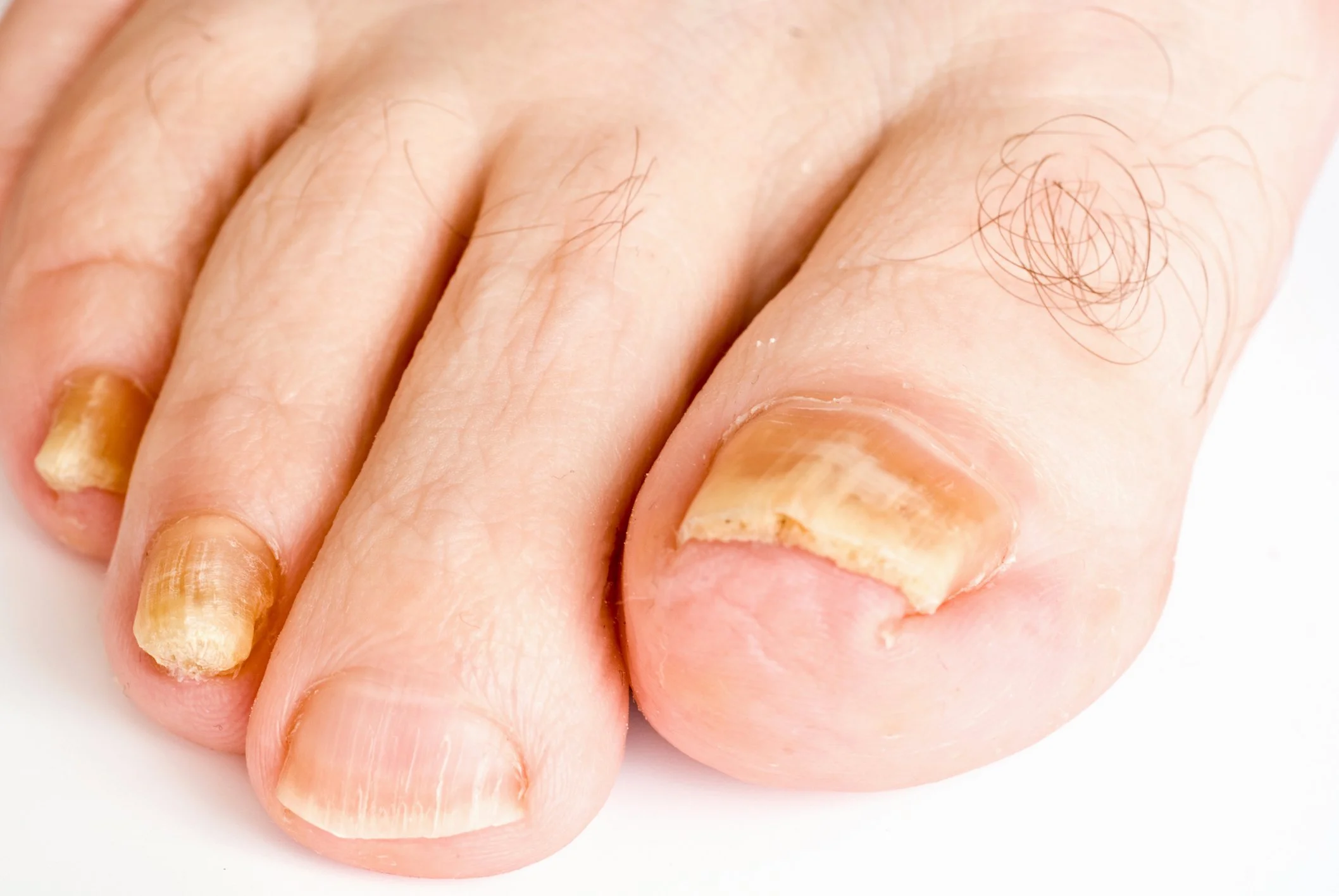 Image of the forefoot with fungal and thickened nail.