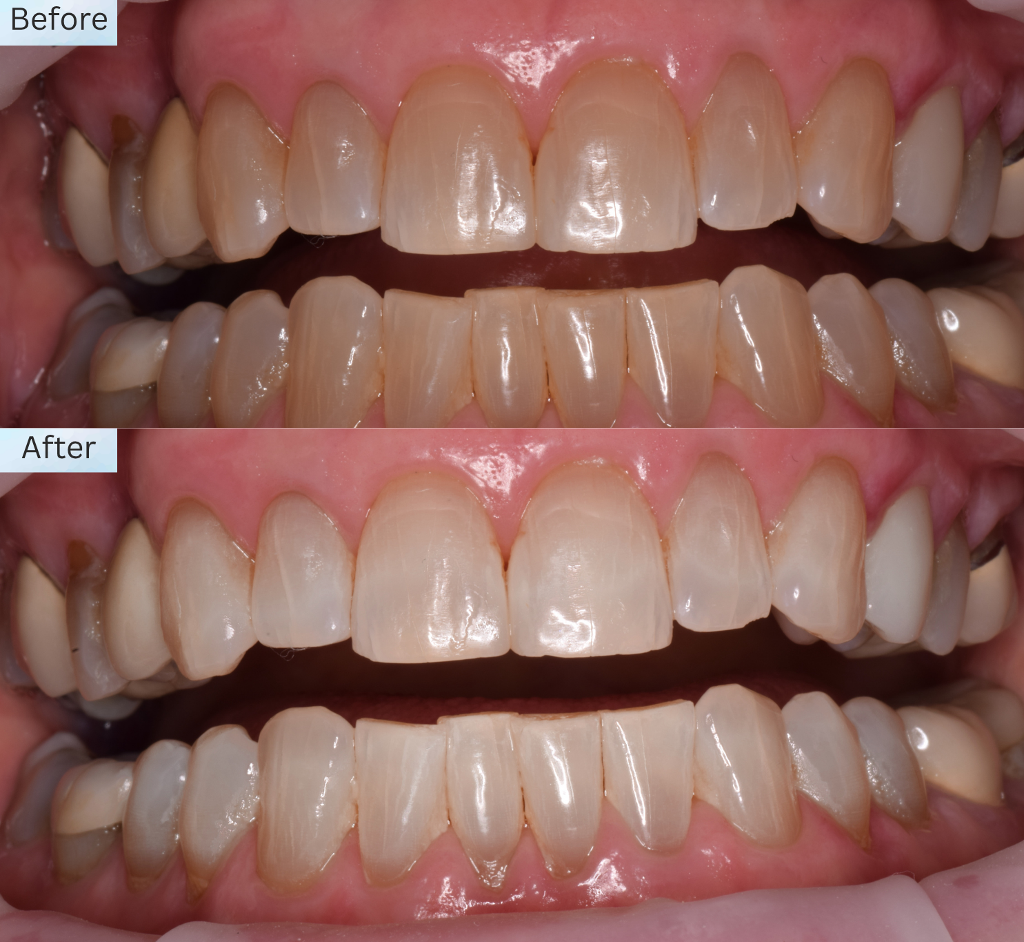 A before and after picture showing the results of professional teeth whitening