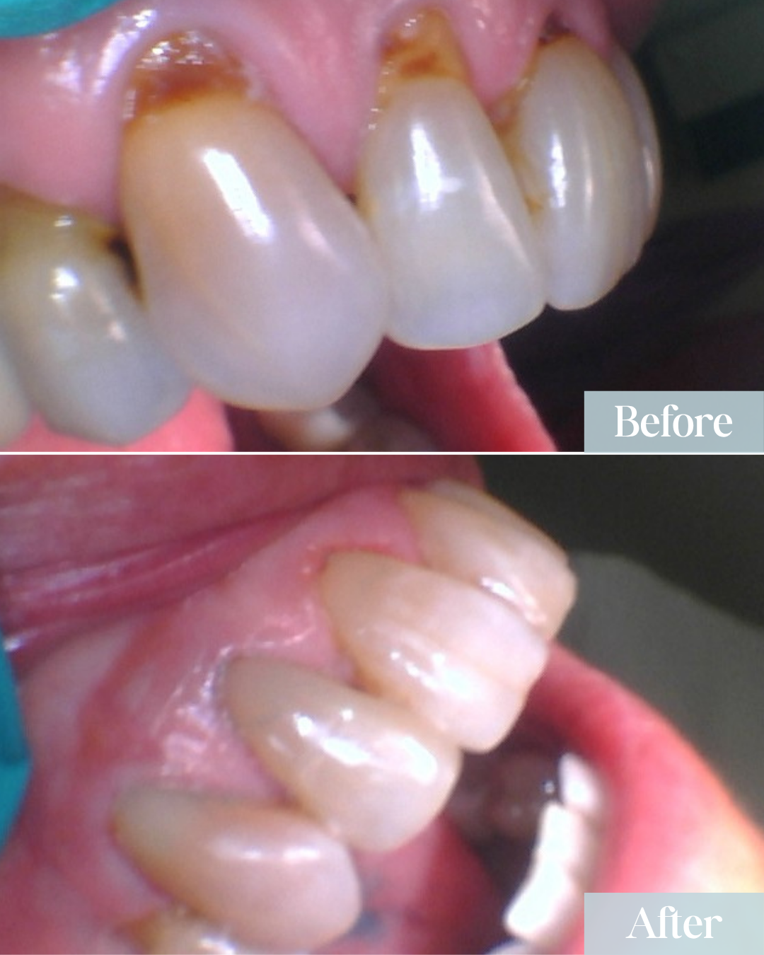 tooth-colored fillings before and after treatment