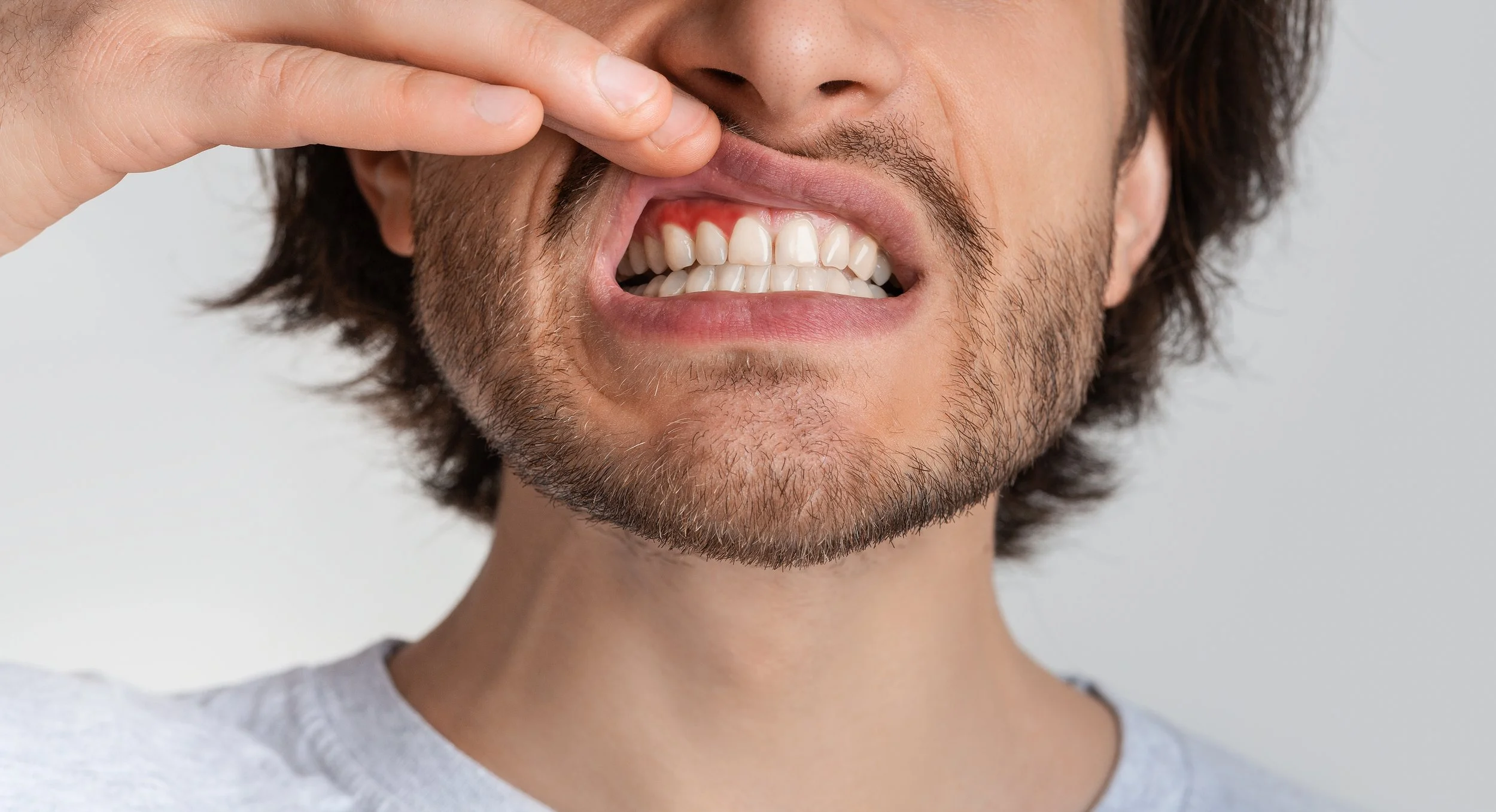 man with facial hair lifting his upper lip to reveal periodontal disease