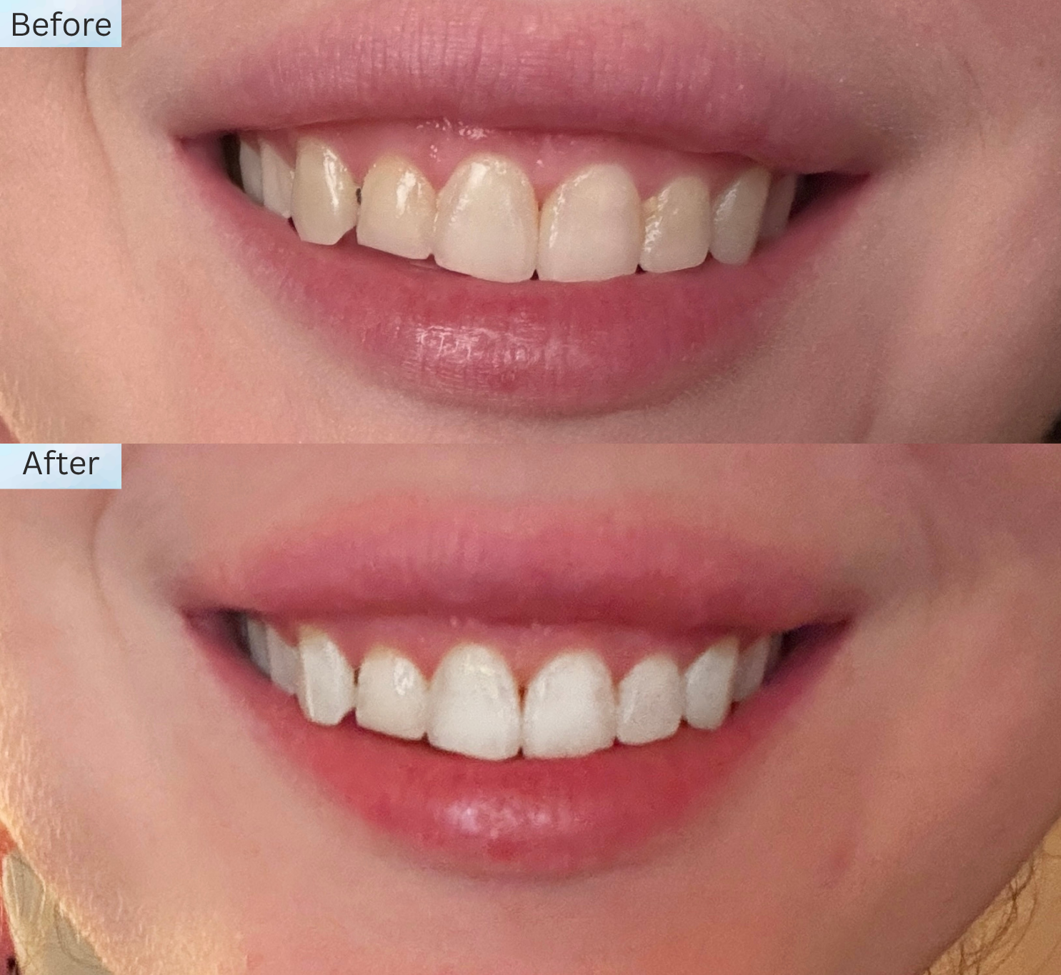 a woman smiling and showing her teeth before and after teeth whitening