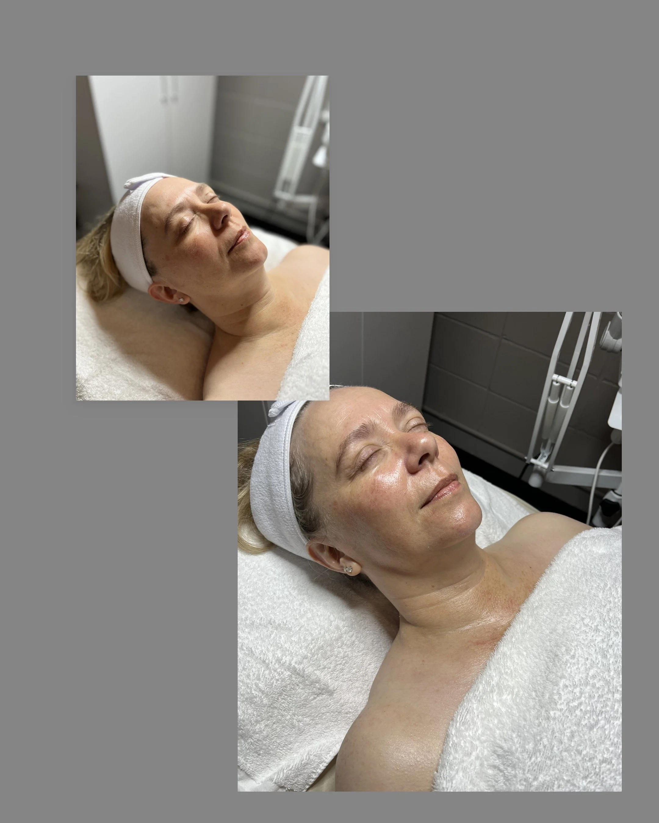 Before and after the LuxeLift facial