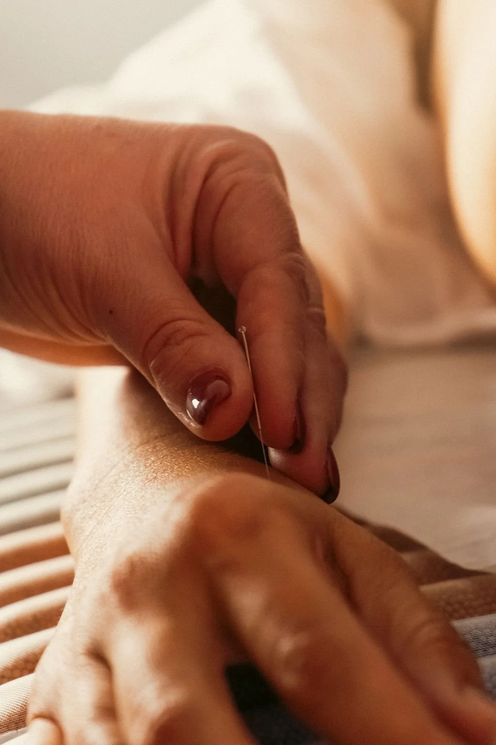 Acupuncture treatment in progress with needles placed gently into the patients wrist