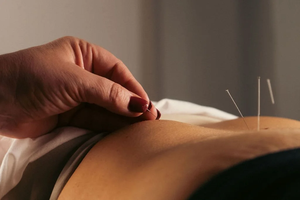 Practitioner performing acupuncture in a calm treatment room