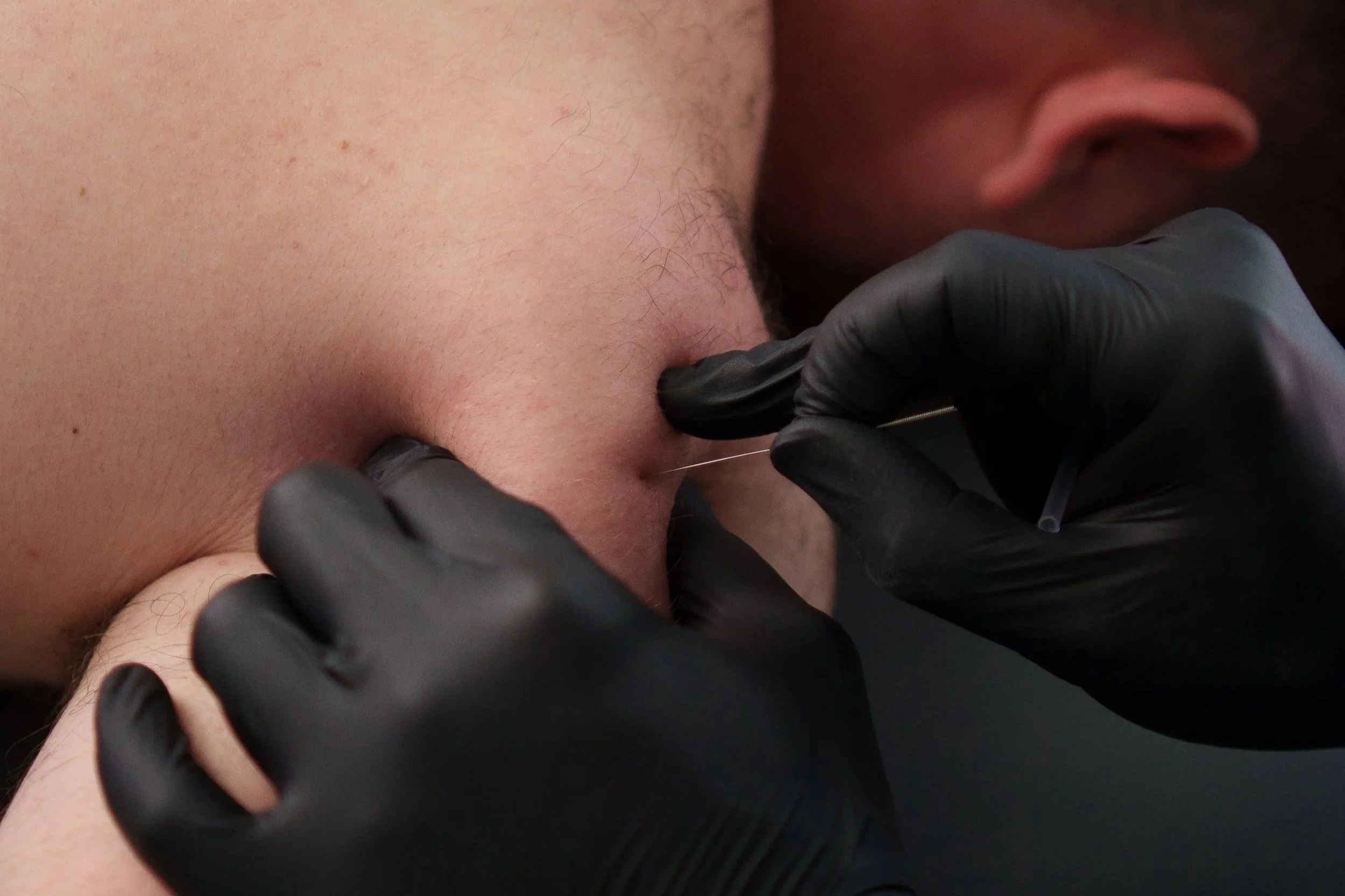 Punción seca para la espalda: una técnica eficaz para aliviar el dolor muscular