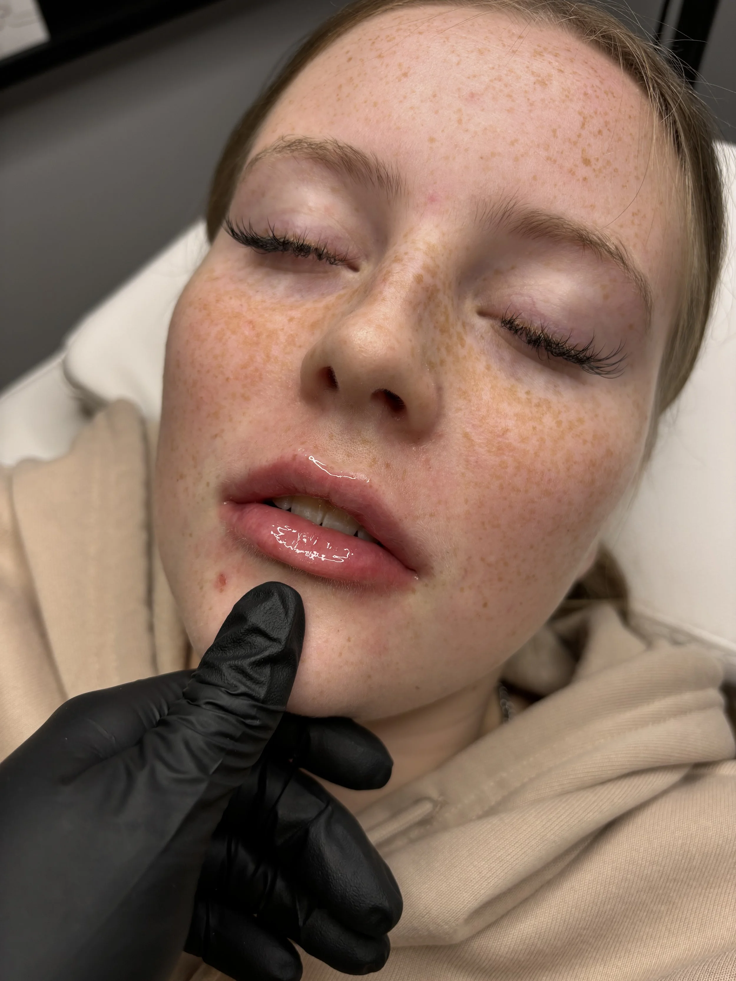 Lip Volume Enhancement