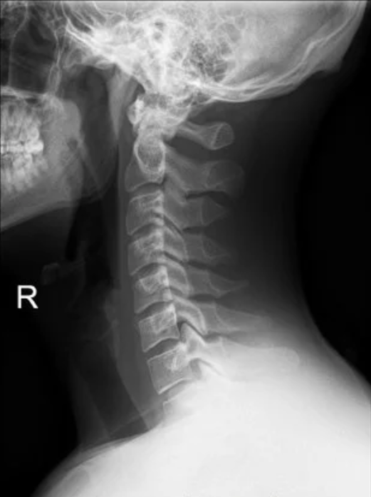 X-ray image of a person's neck and cervical spine showing vertebrae in a lateral view.