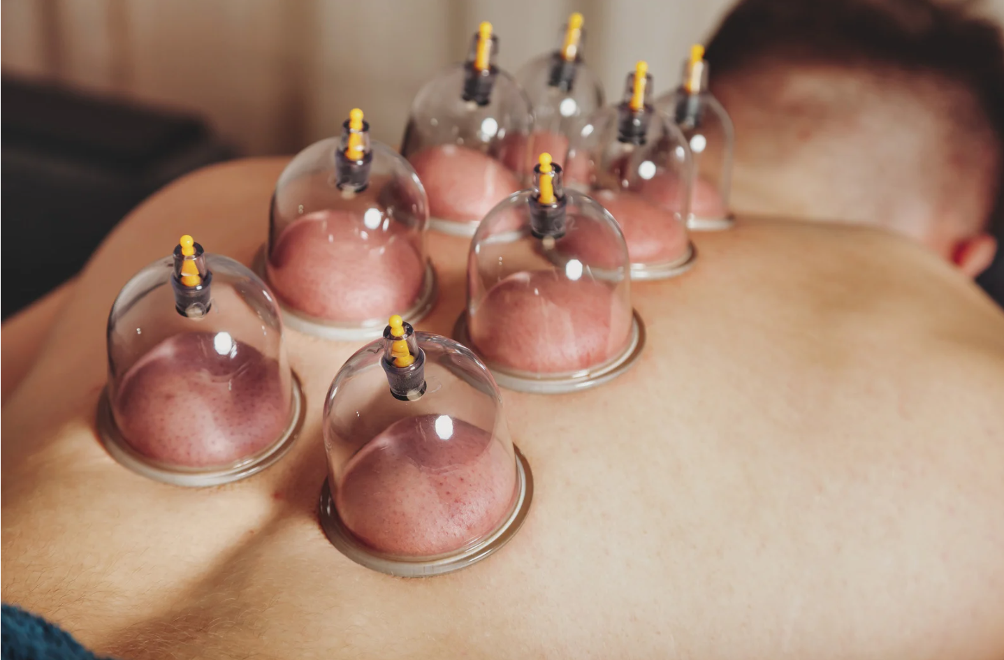 Cupping therapy to relieve muscle tightness and improve mobility