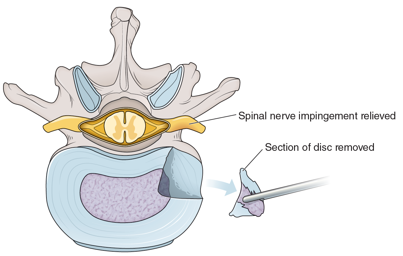 Med vert disc removal.png