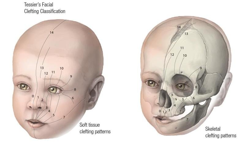 Med clefting patterns.jpg