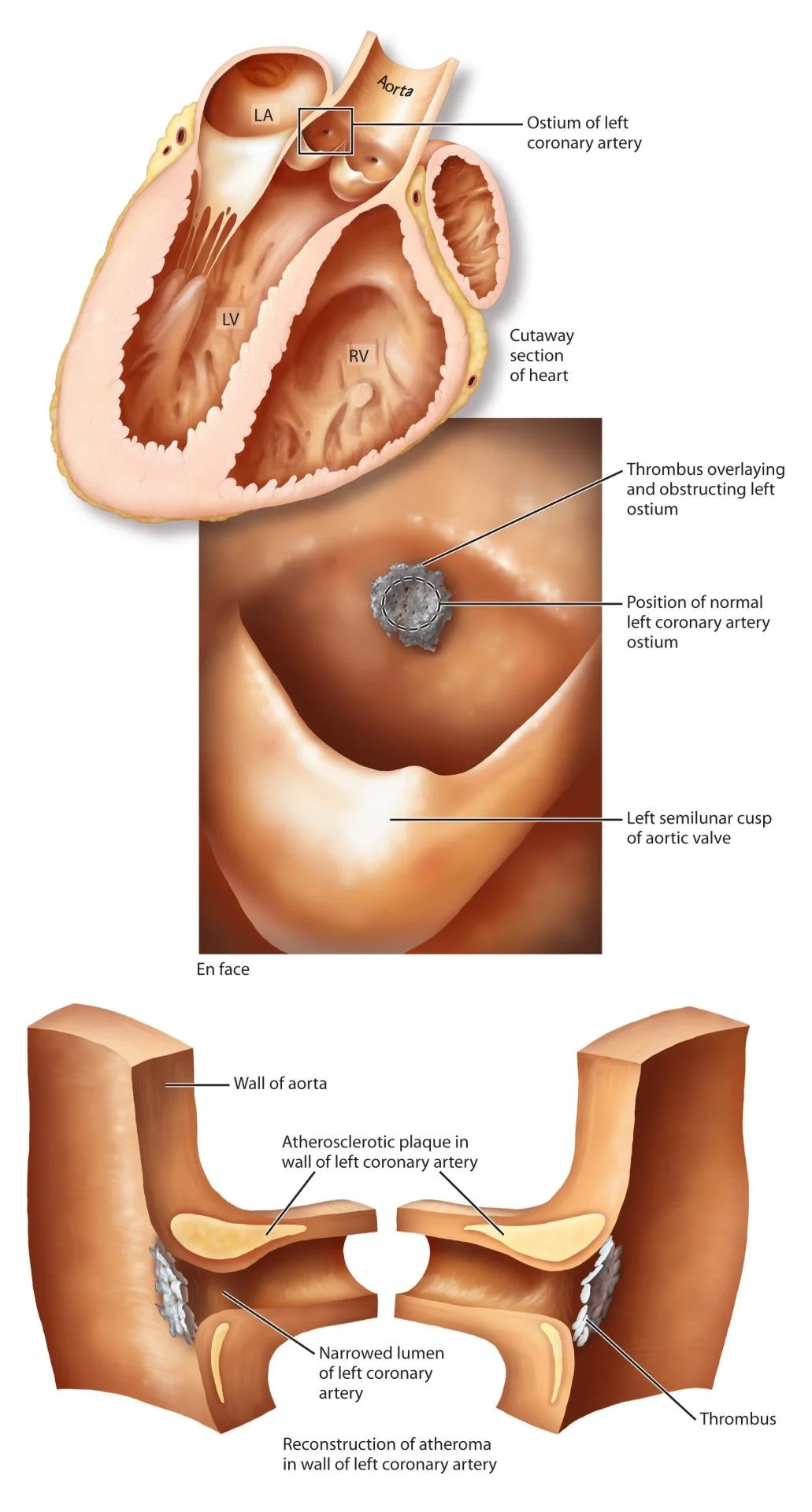 Med ostium blockage.jpg