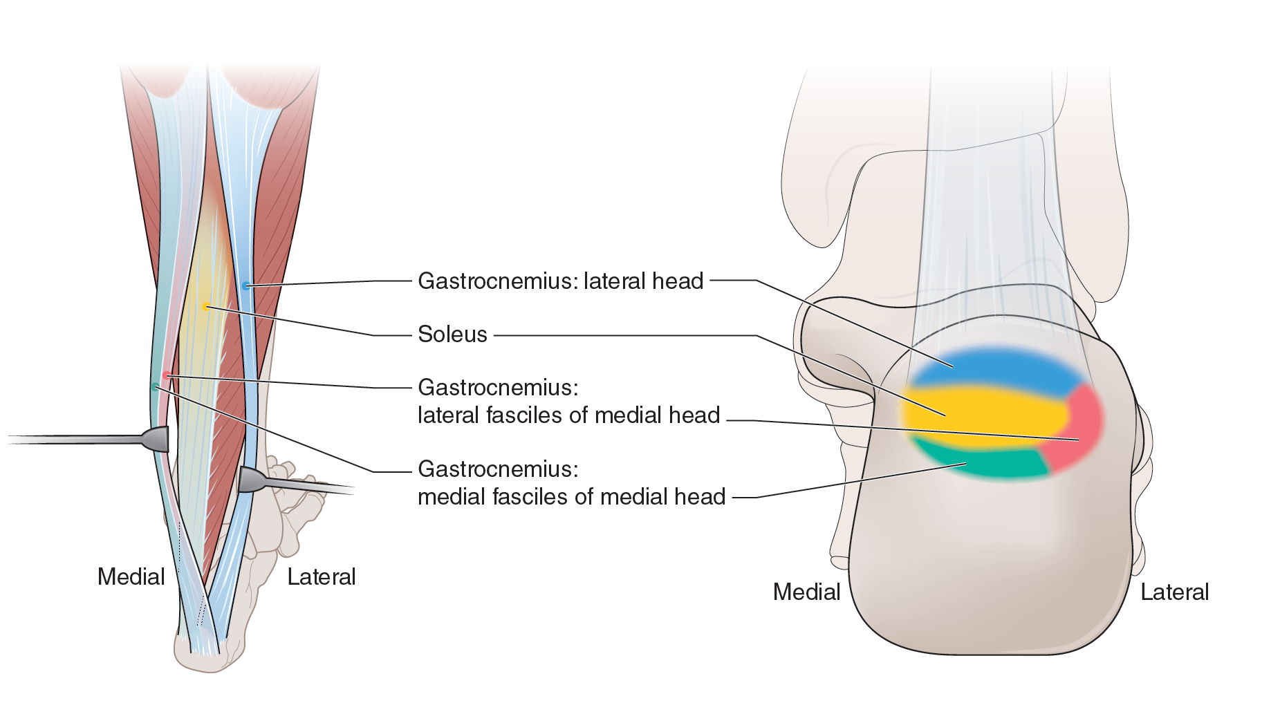Med achilles tendon parts.png