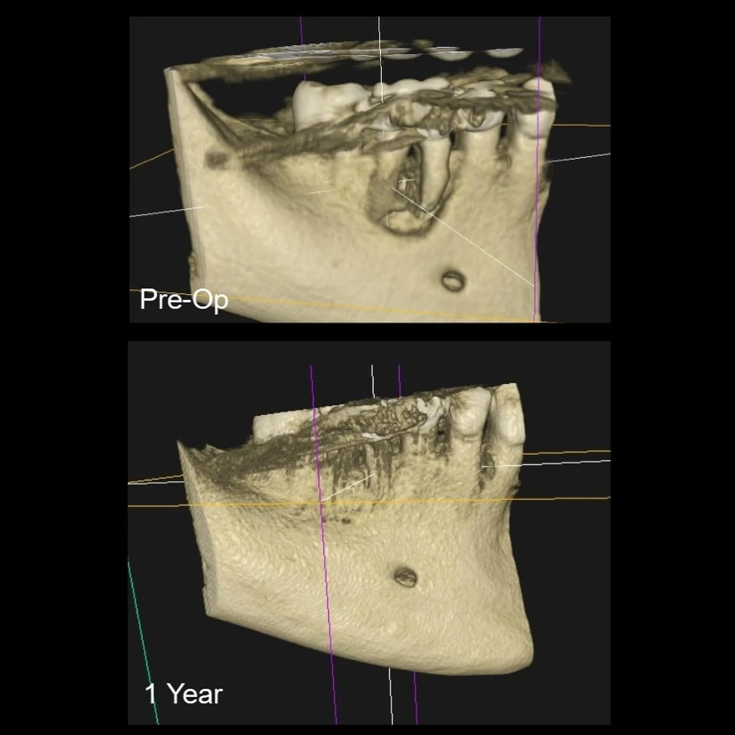 Root canal treatment of tooth #30 with a 1 year follow up showing buccal cortical plate healing. Calcium hydroxide was placed twice over 4 months due to a persistent sinus tract. #endodontist #saveteeth #dentist