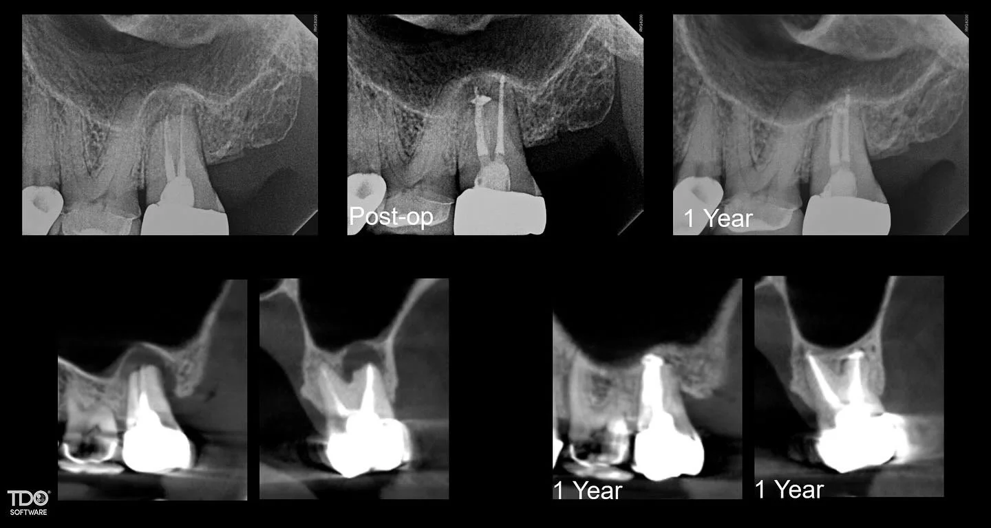 This 1 year follow up of a retreatment shows incredible bone healing. Recall appointments are my favorite &mdash; they reinforce that the way my team and I do things works. #endodontics #saveteeth #rootcanal