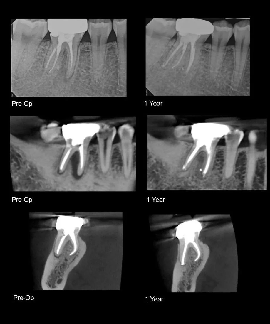 1 year eval on a single visit retreatment of a radix. #endodontics #saveteeth