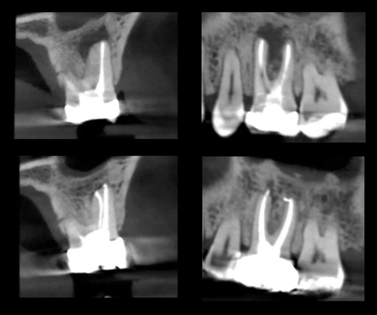 One year recall on tooth 14. History of swelling which resolved after retreatment. The MB2 is usually there.