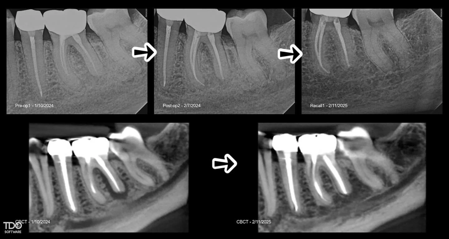 Retreatment of Tooth #19 Prior RCT/SAP. Chewing pain resolved at the second visit. J-shaped lesion healing well at the 1 year recall. #rootcanals #endodontics #saveteeth