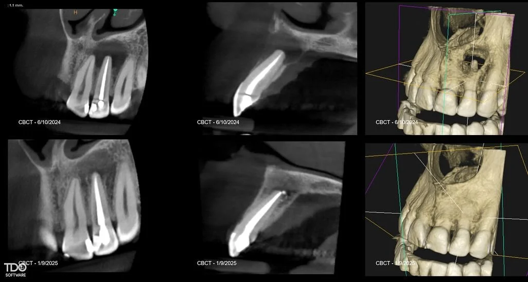 Tooth #10 Prior RCT/CAA. EdgePro laser activated irrigation. Sinus tract healed after one month in calcium hydroxide. Buccal plate healing nicely at the 6 month recall. #rootcanals #saveteeth #endodontics #laser