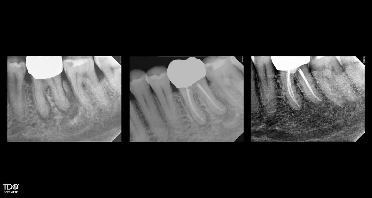 3 years later. More bone, more life. #endodontist #saveteeth #rootcanals #stlouis
