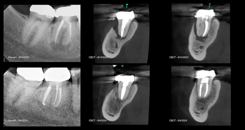 1 year recall on #30 retreatment. Classic pre-op thermafil look. Great healing. #stlouis #rootcanals #endodontics #saveteeth