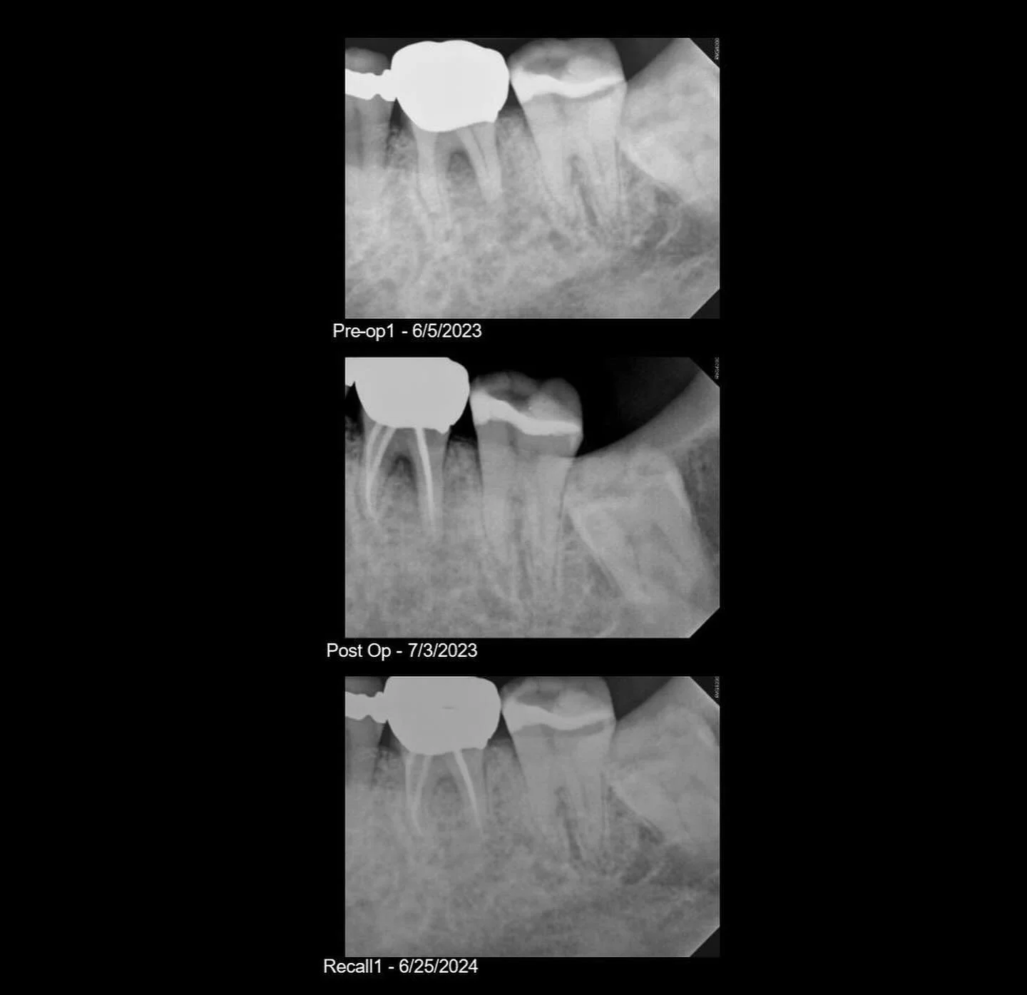 Necrotic Pulp/CAA root canal treatment using the Edgepro laser. Amazing healing at the 1 year recall. #rootcanal #endodontist #saveteeth #stlouis