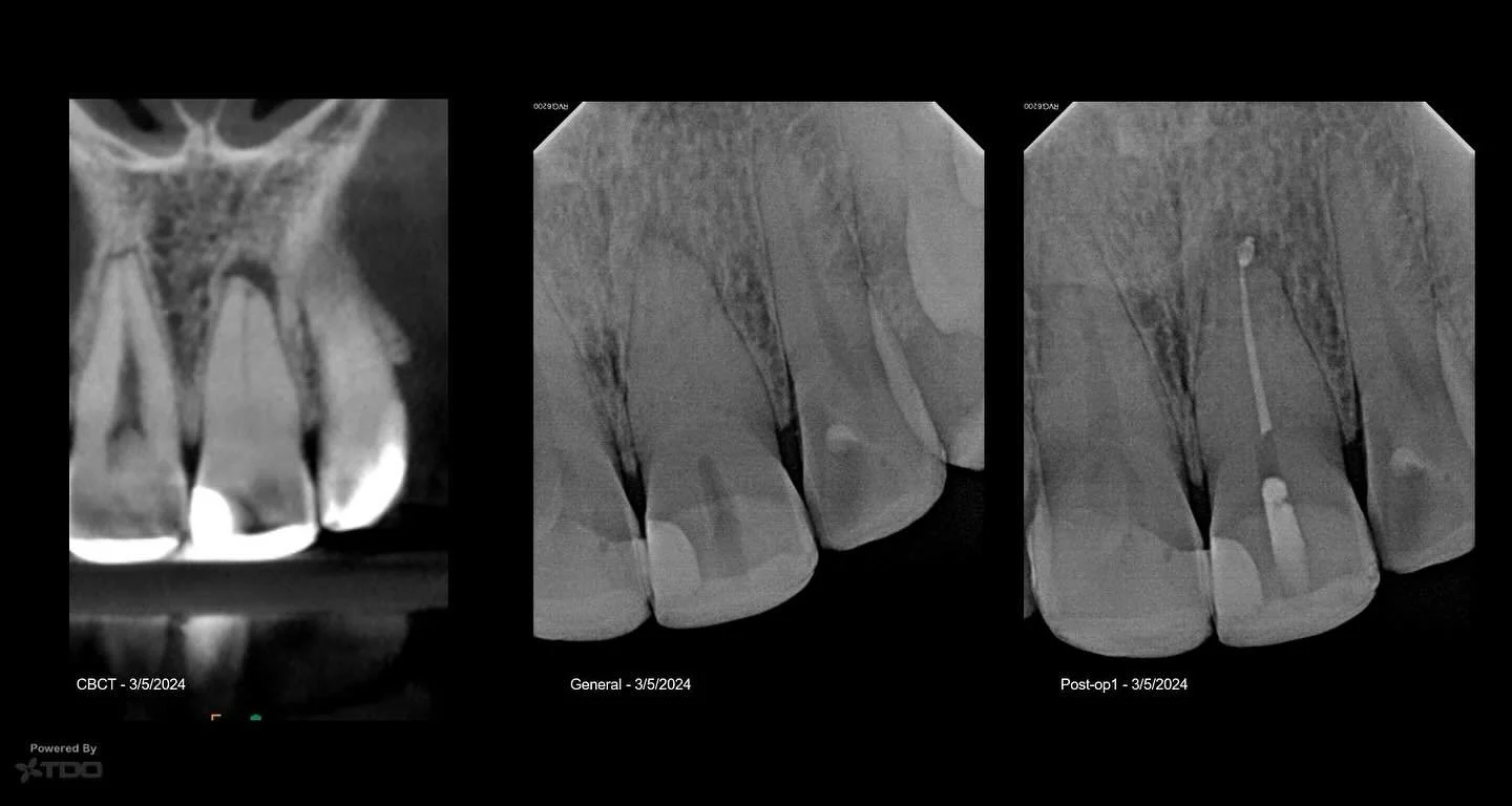 A midpoint radiograph could be the difference between a good vs bad day. Laser assisted irrigation. #edgepro #endodontics #rootcanals #laser