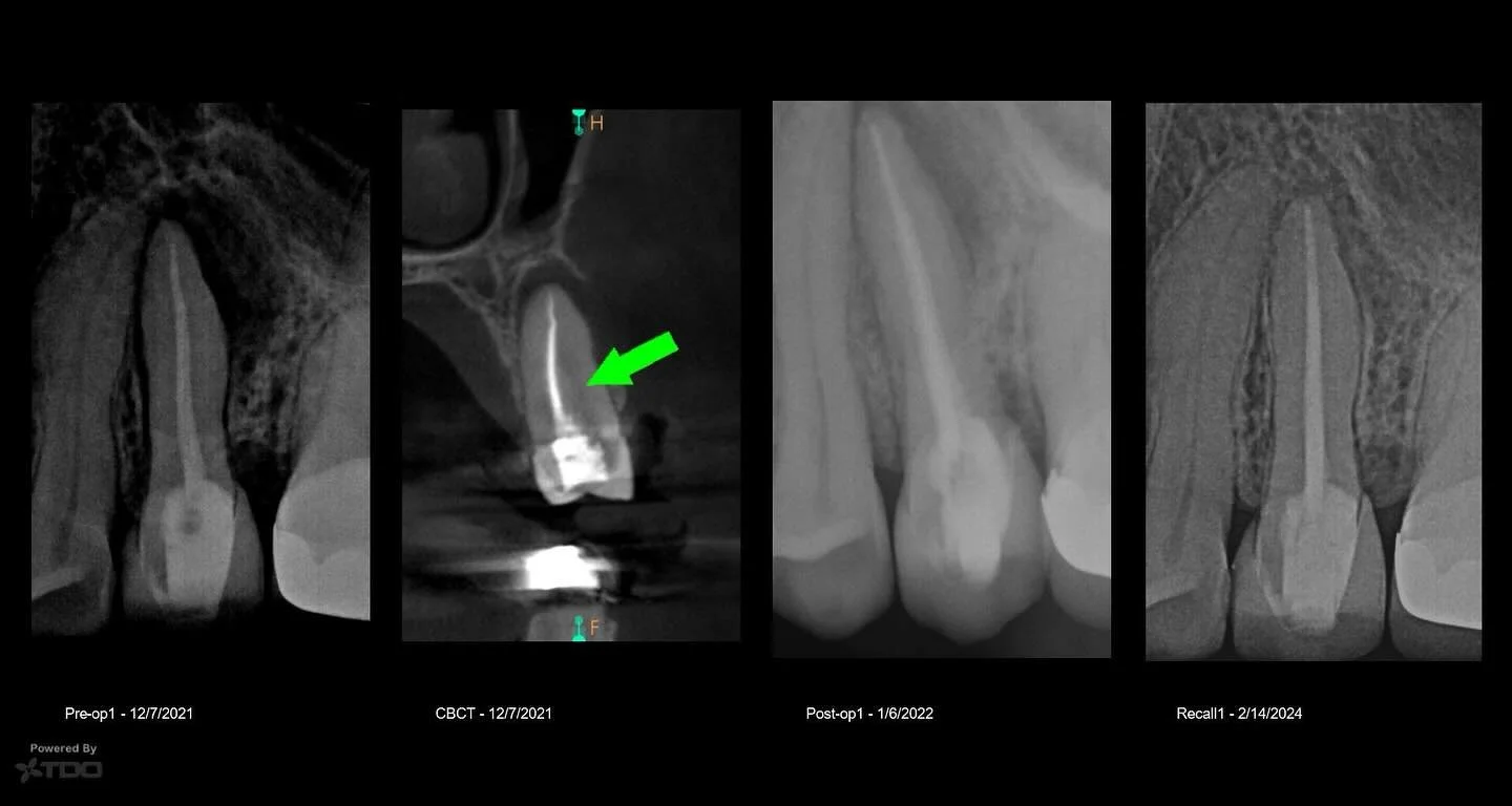 2 year recall on a 2 canal 2nd premolar retreatment. Voila bone growth!  #dentistry #dental #stlouisendodontist #stlouisdentist #rootcanal #endodontics #endodontist #saveteeth