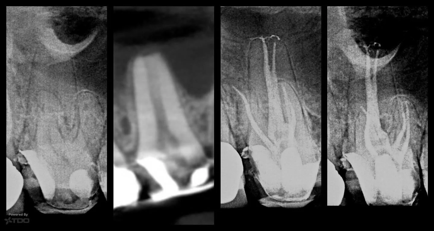 5 canals, 5 exits.  #dentistry #dentist #stlouisendodontist #stlouisdentist #rootcanal #endodontics #endodontist #saveteeth