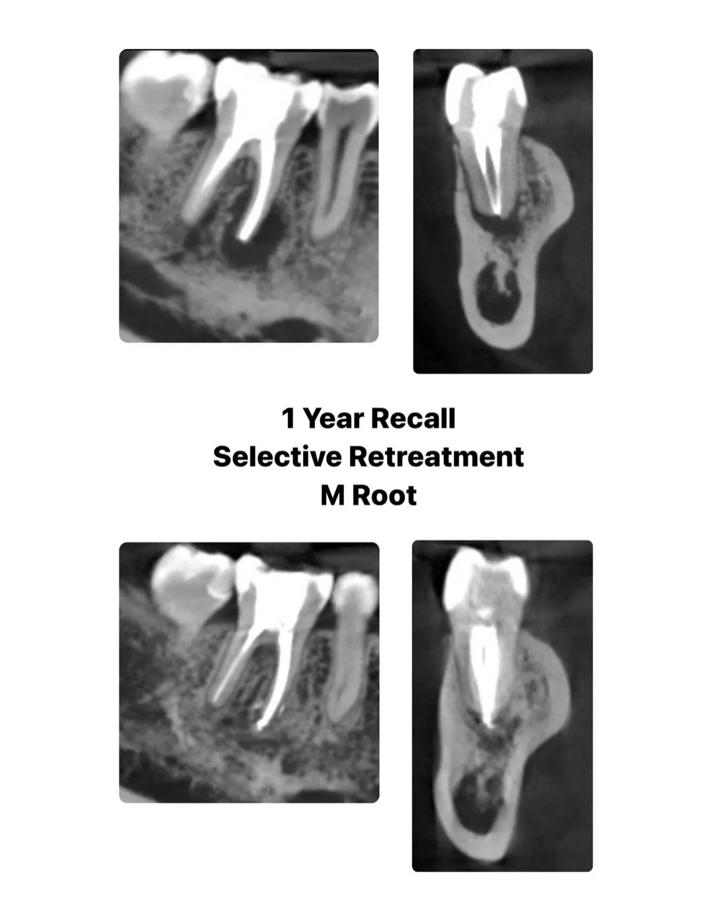 Another day, another tooth saved! 🦷🪥 #rootcanals #endodontist #stlouisrootcanals