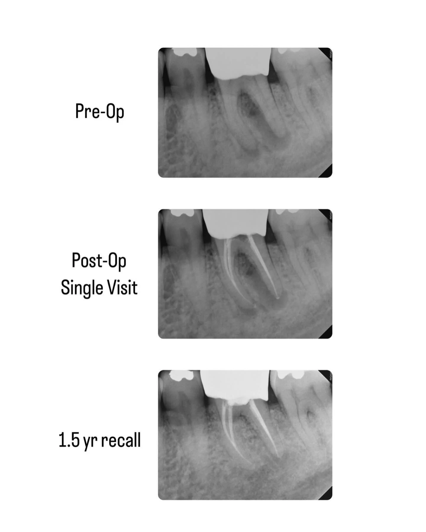 🦷 ✨Root Canal Magic! Incredible journey to health and happiness of this conservatively shaped tooth at its 1.5-year mark 😁. #rootcanalssaveteeth #oralhealth