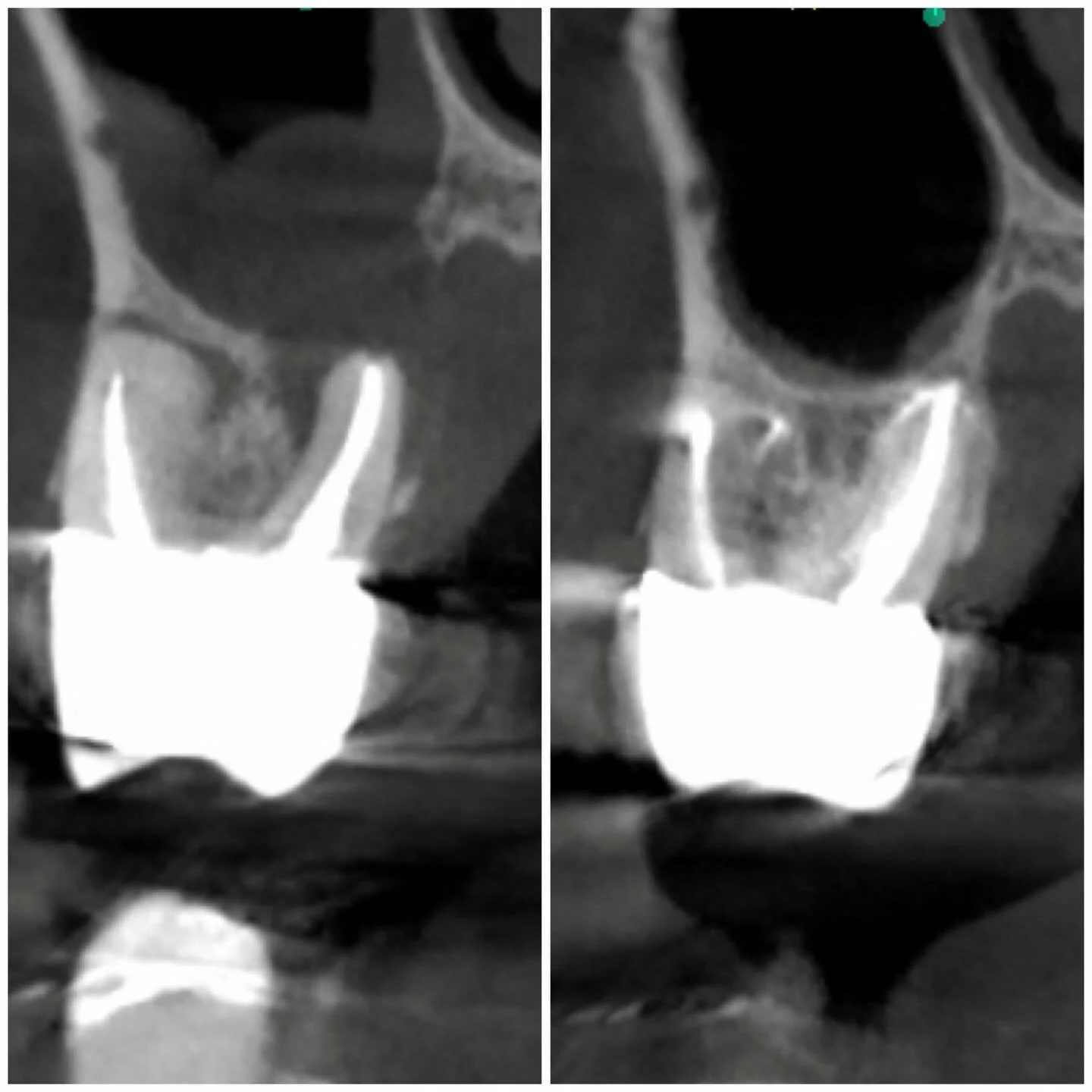 Classic missed MB2 retreatment &hellip; with a sinus communication. Impressive healing at two years. It is amazing what our bodies are capable of. #rootcanals #saveteeth