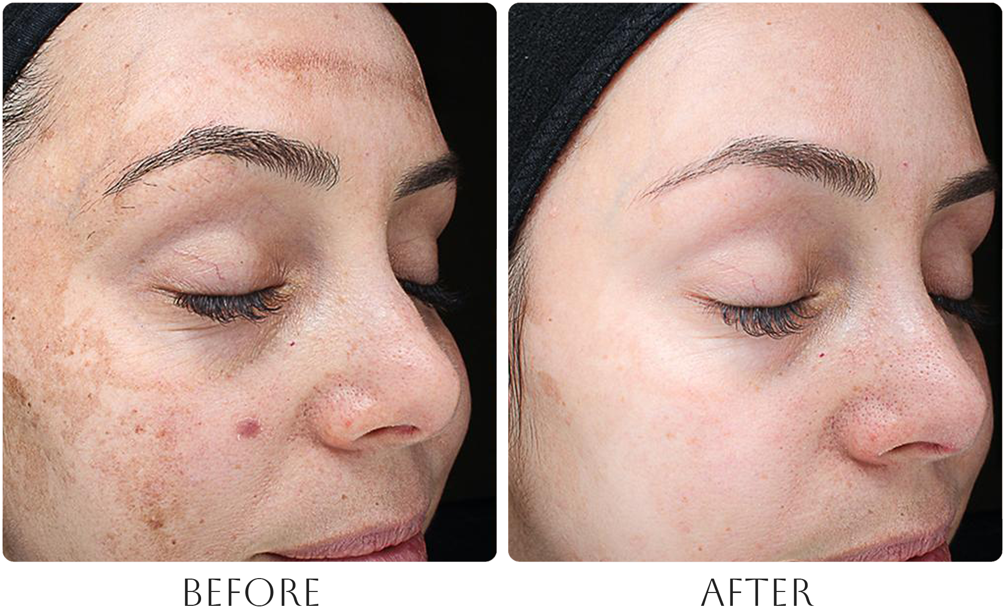 Chemical peel before and after photo