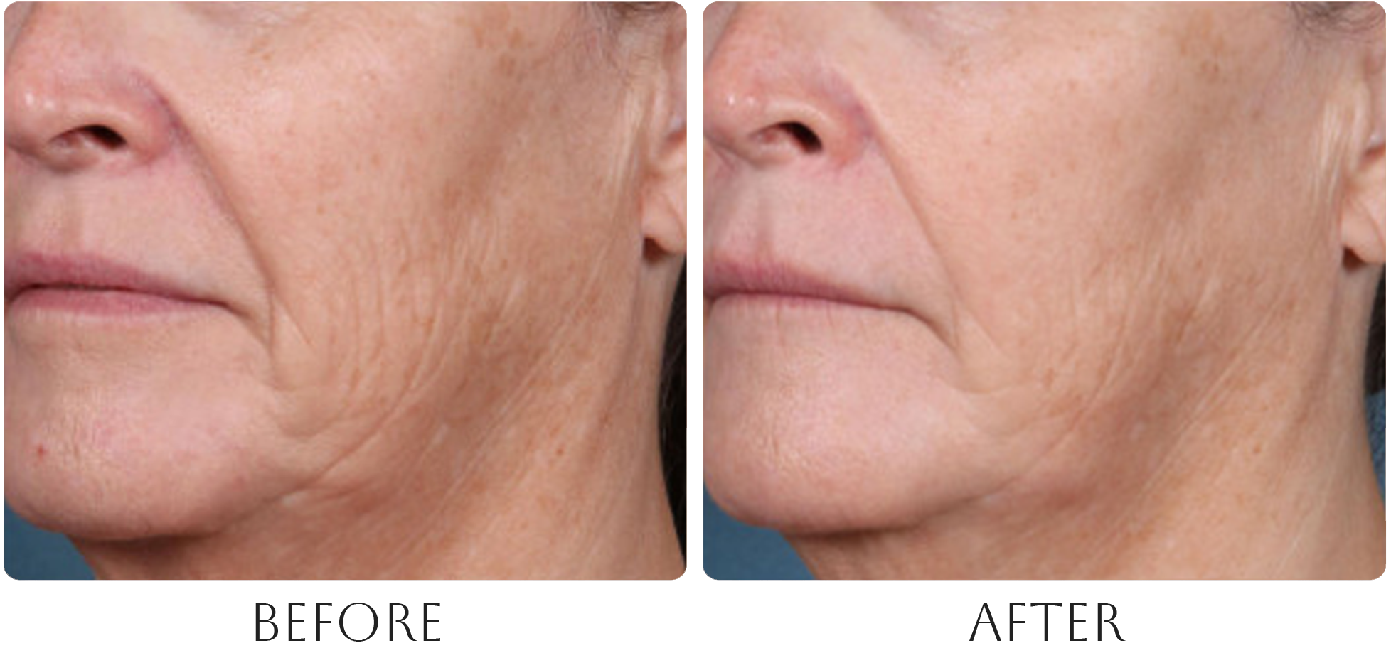 Ellacor before and after photo