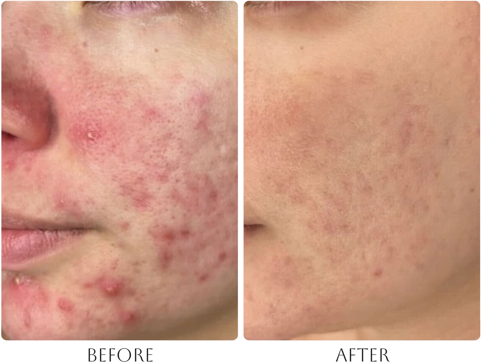AviClear before and after photo