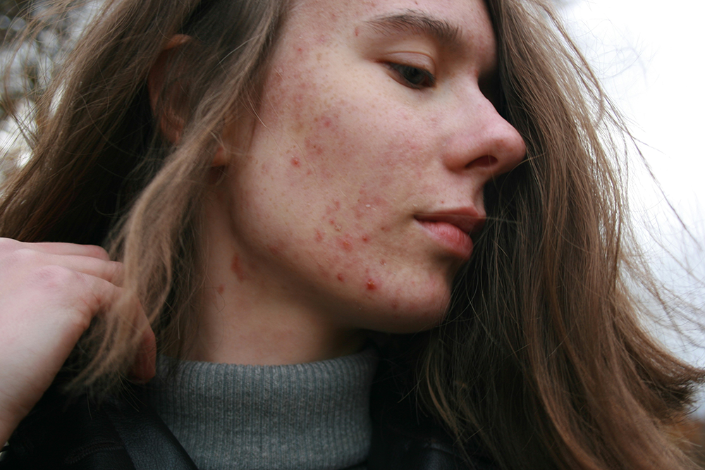 Young woman with acne