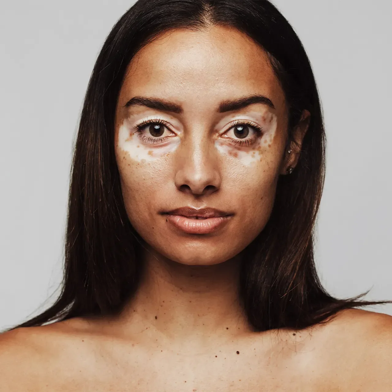 Skin disorders