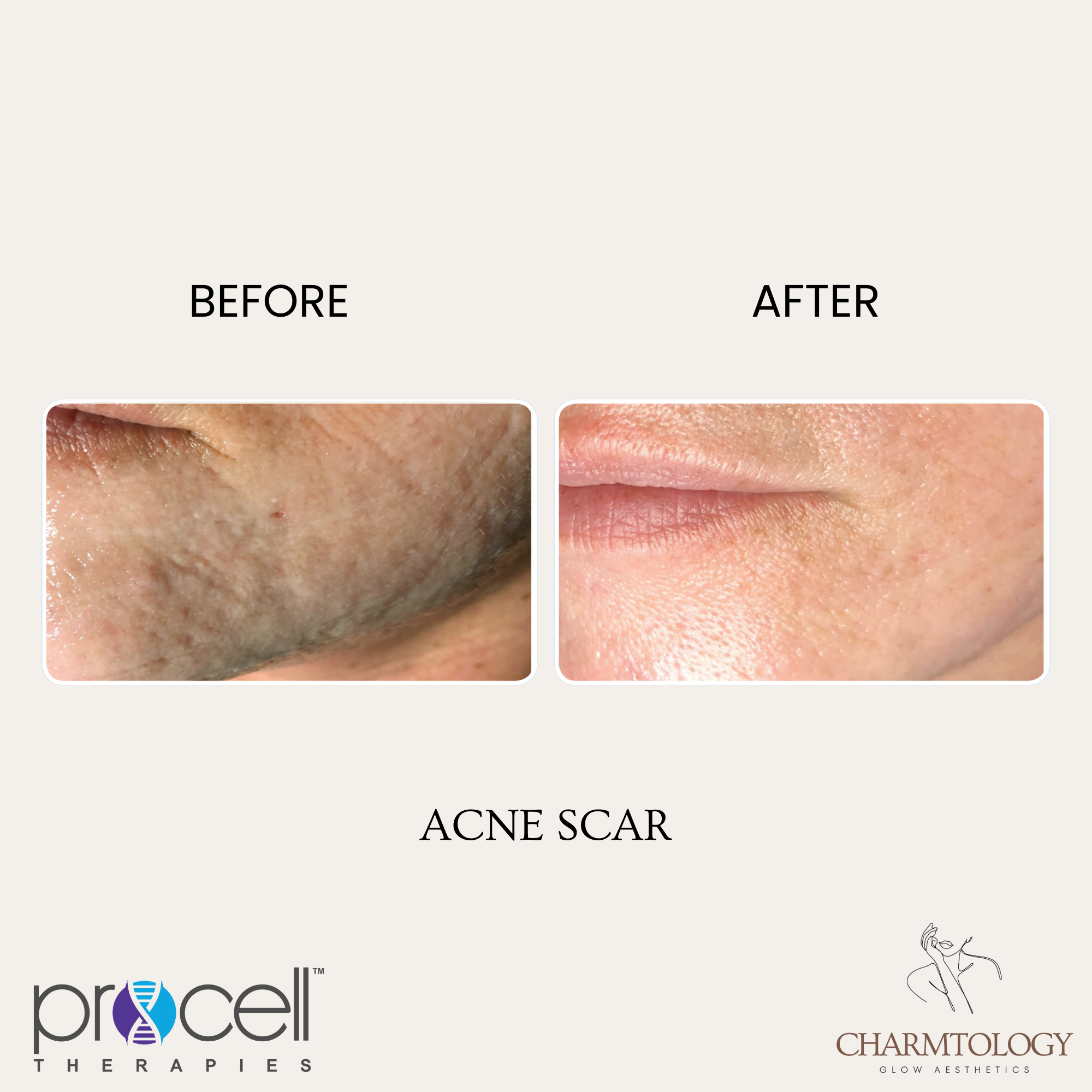 PROCELL - BEFORE AND AFTER - SKIN TIGHTENING 2.png