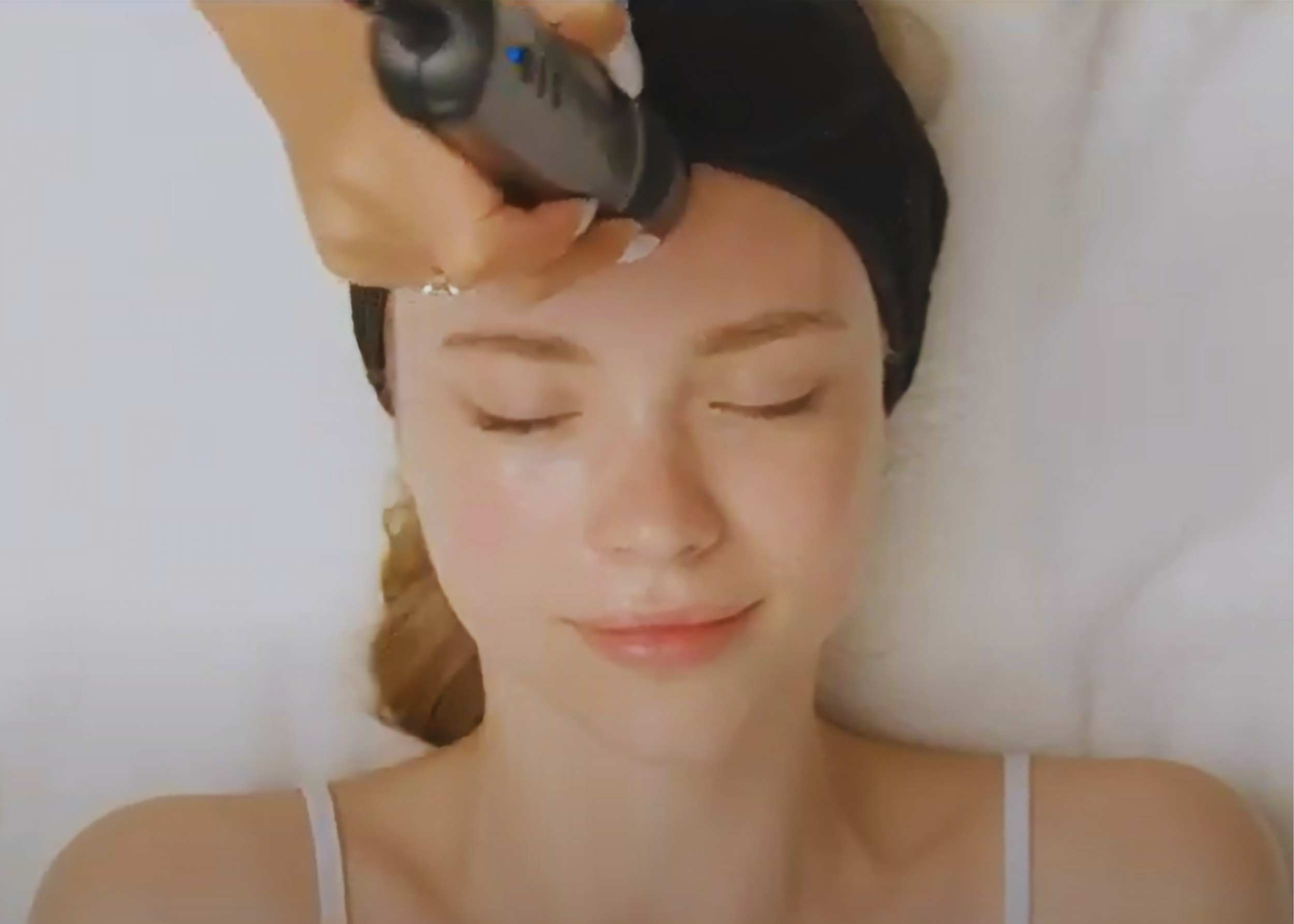 Tripollar® Radio Frequency - Skin Tightening