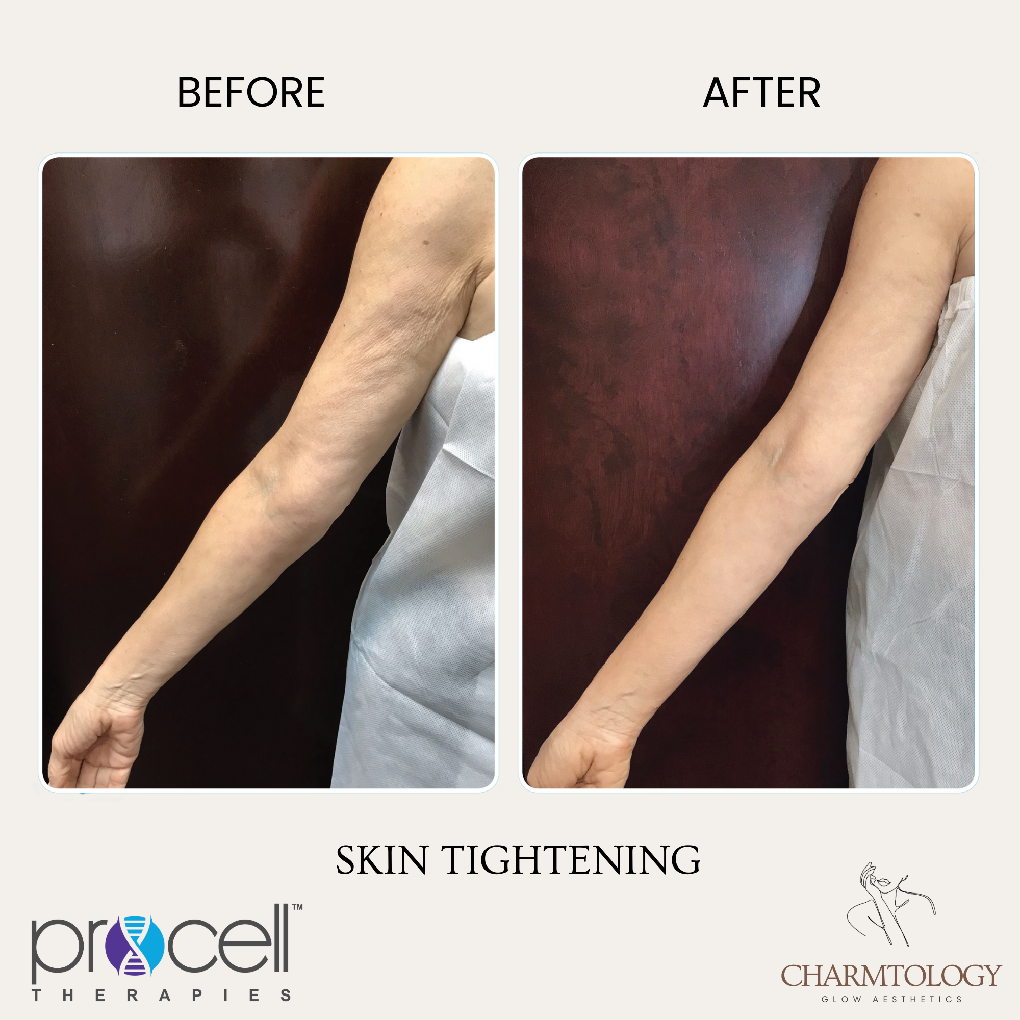 PROCELL - BEFORE AND AFTER - SKIN TIGHTENING 3.png