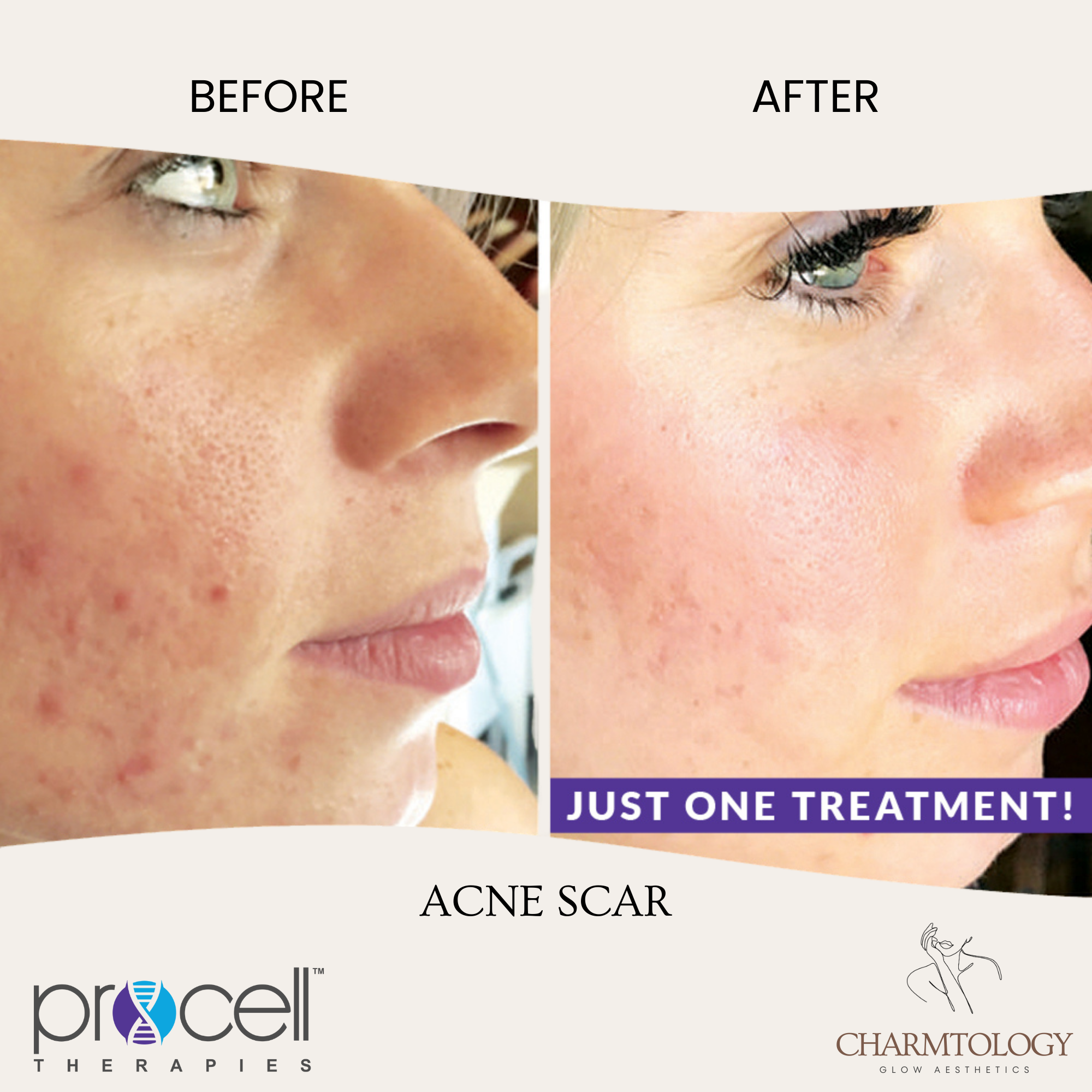 PROCELL - BEFORE AND AFTER - ACNE SCAR 1.png