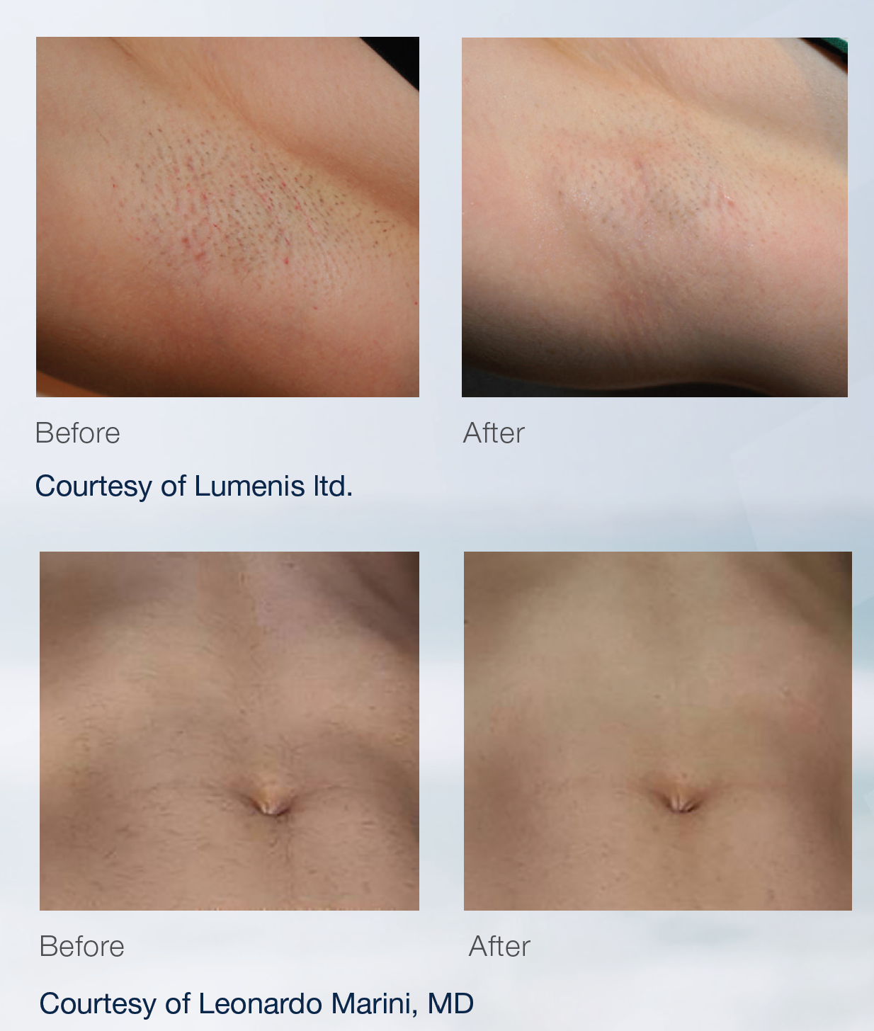 Lumenis Before and After.png