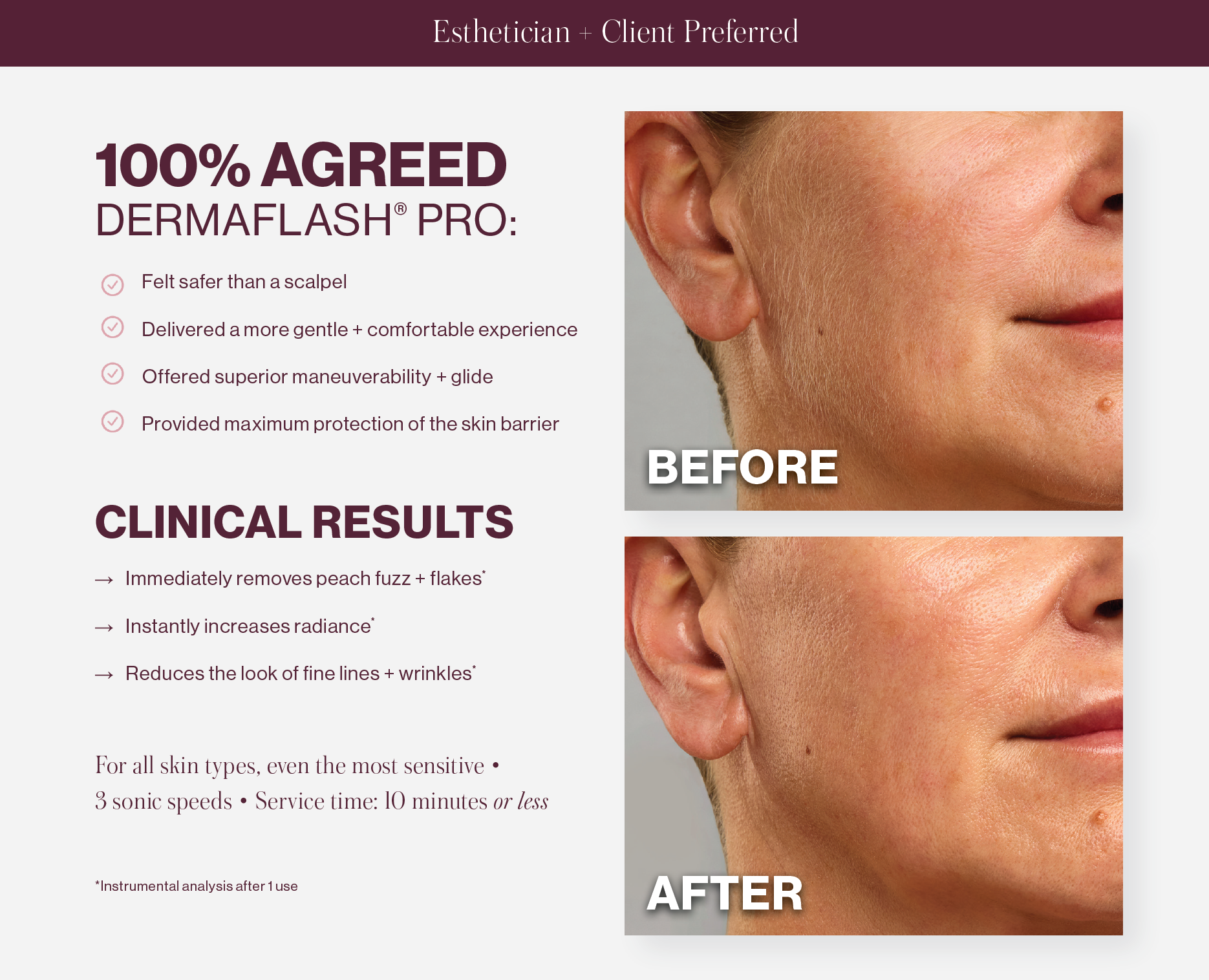 Dermaflash Pro - Charmtology - After.png