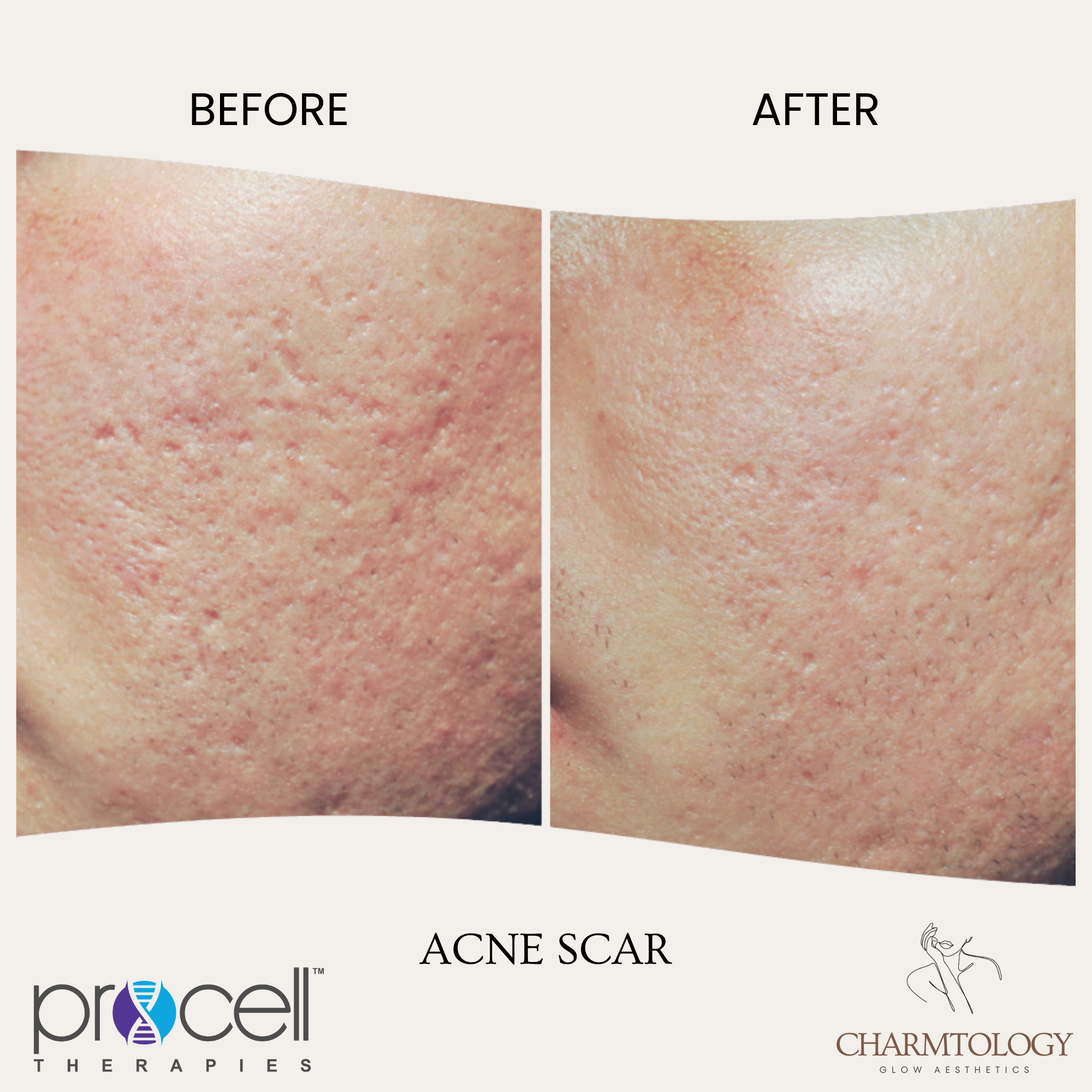PROCELL - BEFORE AND AFTER - ACNE SCAR 2.png