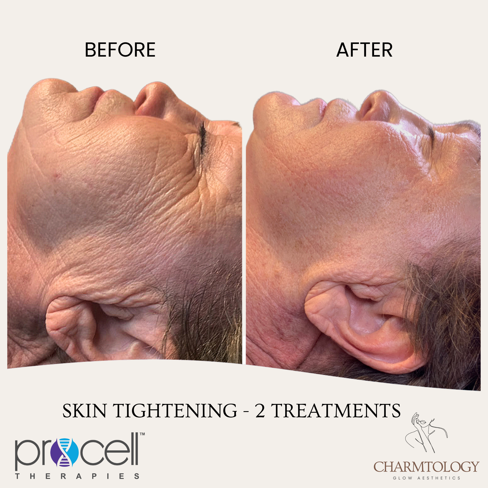 PROCELL - BEFORE AND AFTER - SKIN TIGHTENING 1.png