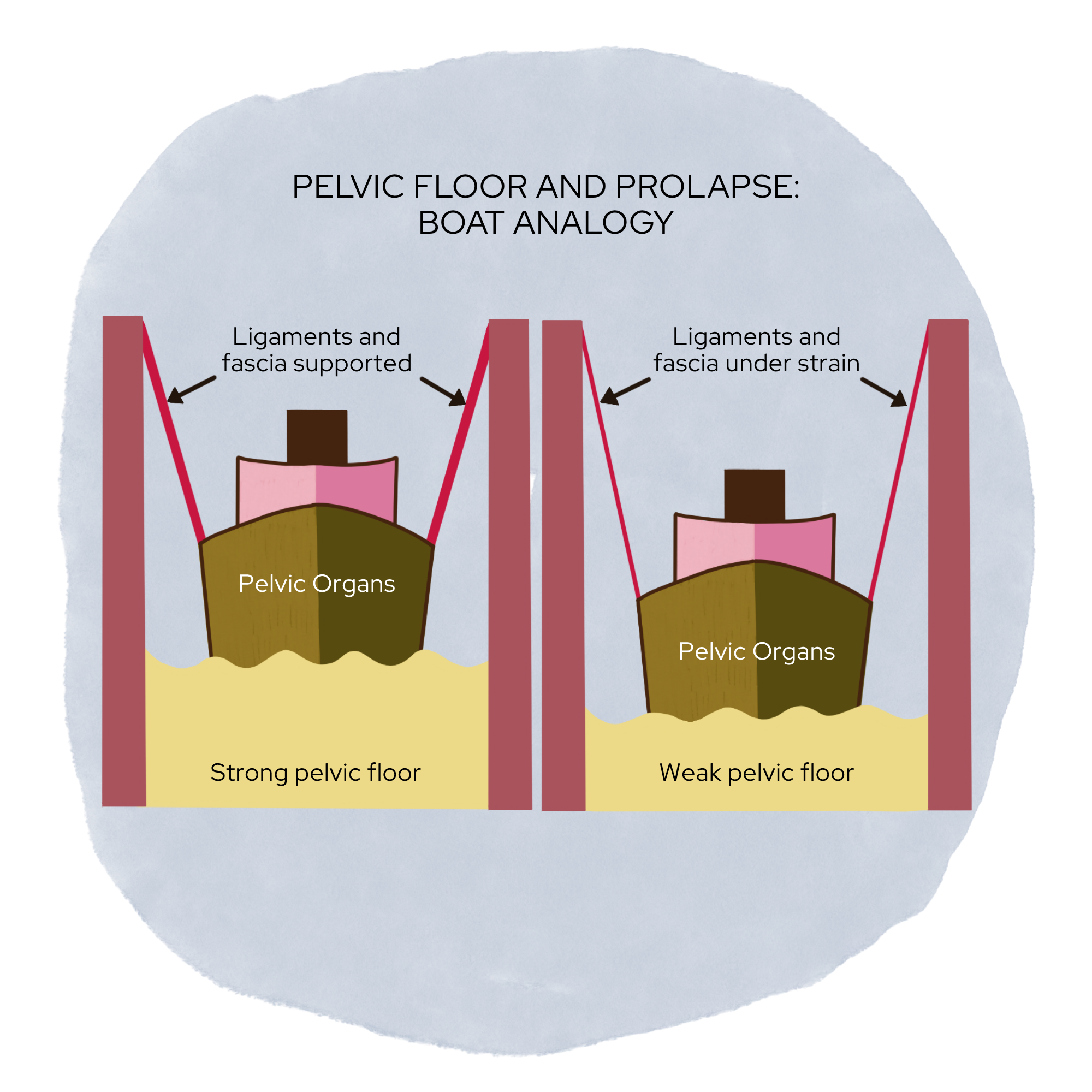 Pelvic Organ Prolapse: What It Is, and Why It Doesn't Mean You Have to Stop Exercising