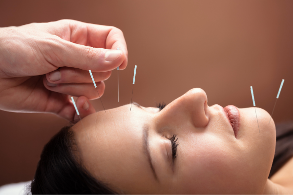 Woman getting acupuncture on her face