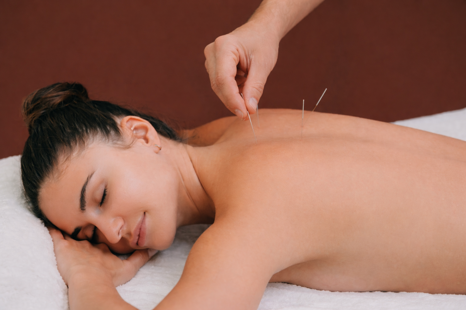 Woman getting acupuncture on her back