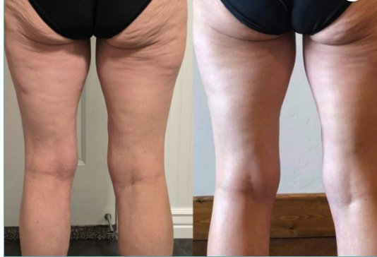 fanny facial, tighten, firm, cellulite reduction,